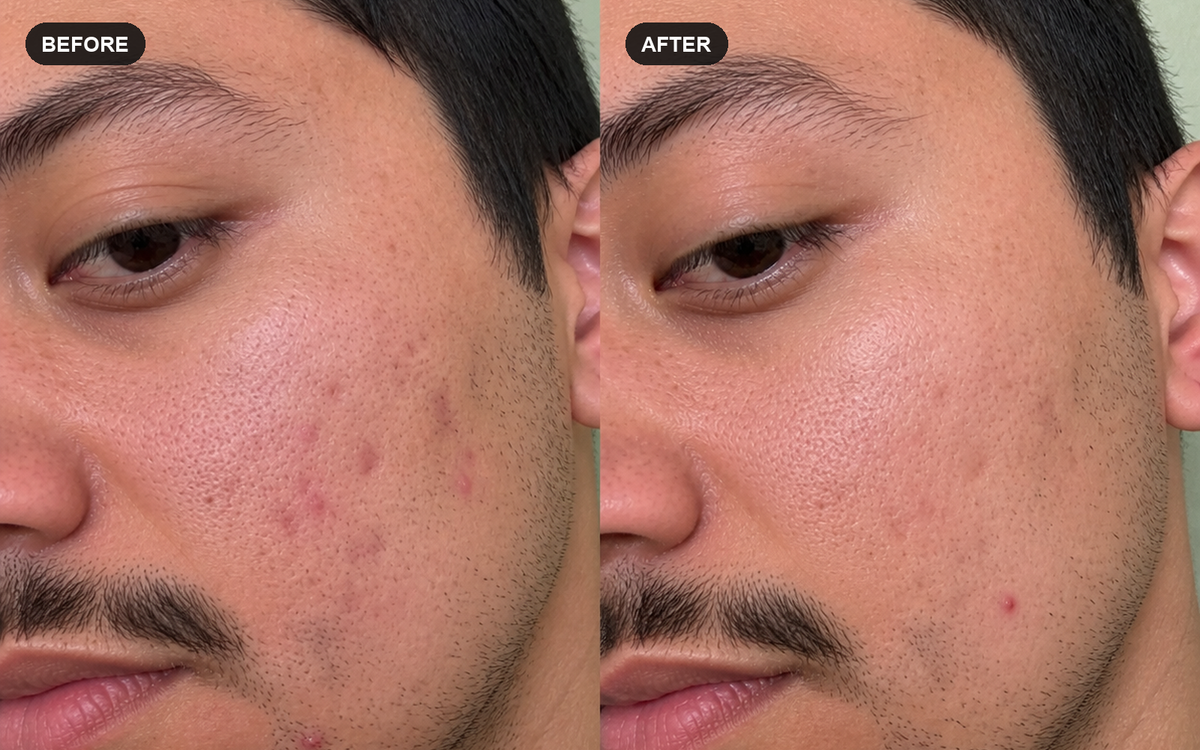 Close-up illustrative before and after comparison for breakout-conscious skincare